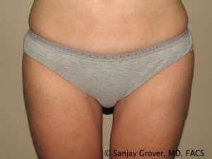 Liposuction Before and After | Grover Aesthetics