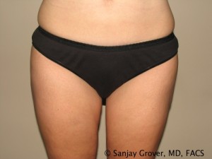 Liposuction Before and After 19 | Sanjay Grover MD FACS