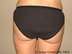 Liposuction Before and After 19 | Sanjay Grover MD FACS