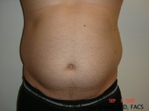 Liposuction Before and After 16 | Sanjay Grover MD FACS