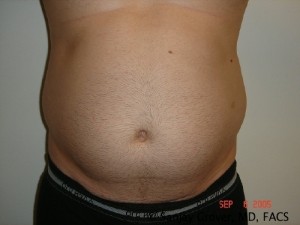 Liposuction Before and After | Grover Aesthetics