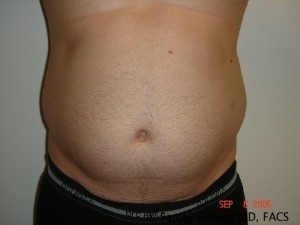 Liposuction Before and After 37 | Sanjay Grover MD FACS