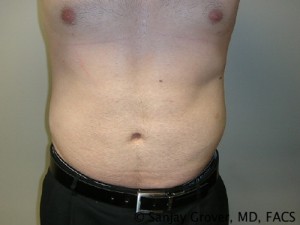 Liposuction Before and After | Sanjay Grover MD FACS