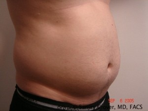 Liposuction Before and After 20 | Grover Aesthetics