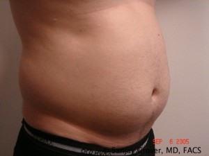 Liposuction Before and After 20 | Sanjay Grover MD FACS