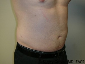 Liposuction Before and After 20 | Sanjay Grover MD FACS