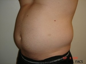 Liposuction Before and After 20 | Grover Aesthetics