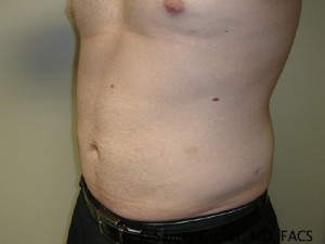 Liposuction Before and After 20 | Sanjay Grover MD FACS