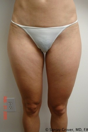 Liposuction Before and After | Grover Aesthetics
