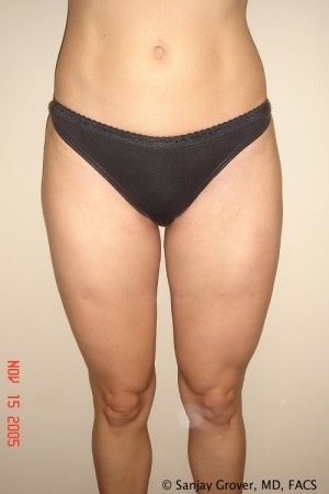 Liposuction Before and After | Grover Aesthetics