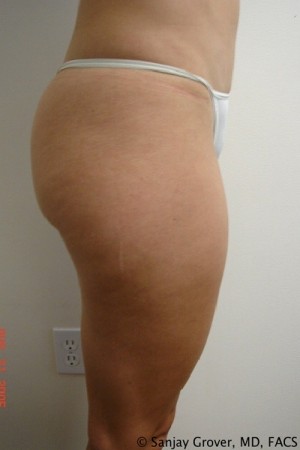 Liposuction Before and After 21 | Grover Aesthetics
