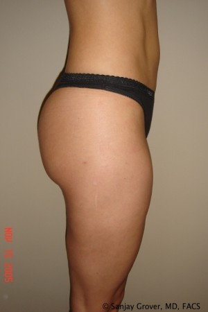 Liposuction Before and After 21 | Grover Aesthetics