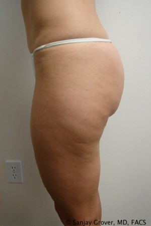 Liposuction Before and After 21 | Grover Aesthetics