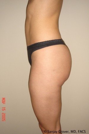 Liposuction Before and After 21 | Grover Aesthetics