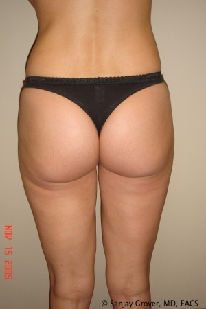 Liposuction Before and After 21 | Grover Aesthetics