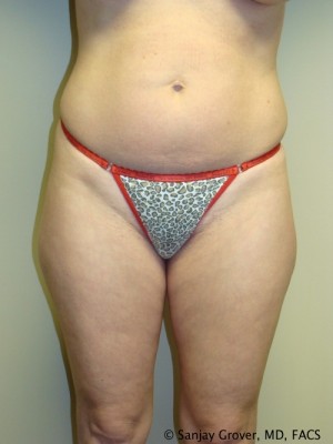 Liposuction Before and After | Grover Aesthetics