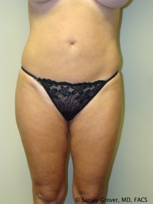 Liposuction Before and After | Grover Aesthetics