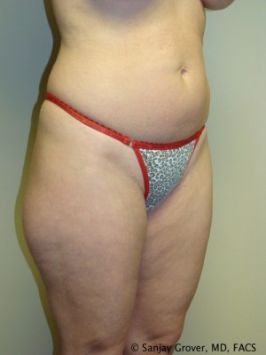 Liposuction Before and After 22 | Grover Aesthetics