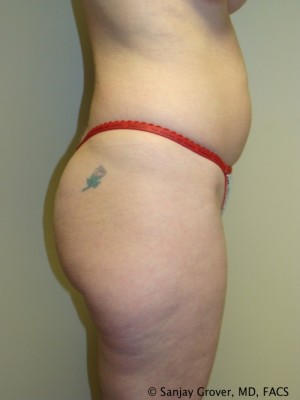 Liposuction Before and After 22 | Grover Aesthetics