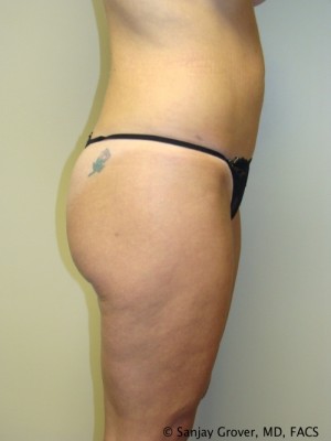 Liposuction Before and After 22 | Grover Aesthetics