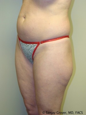 Liposuction Before and After 22 | Grover Aesthetics