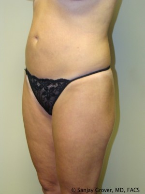 Liposuction Before and After 22 | Sanjay Grover MD FACS