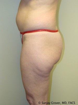 Liposuction Before and After 22 | Grover Aesthetics