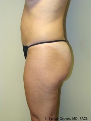 Liposuction Before and After 22 | Sanjay Grover MD FACS