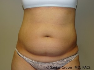Liposuction Before and After 41 | Sanjay Grover MD FACS