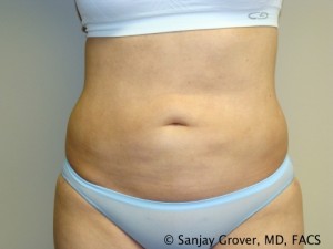 Liposuction Before and After | Grover Aesthetics