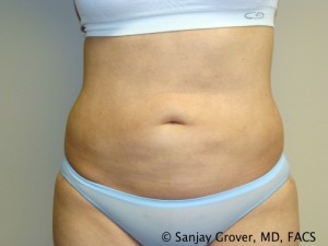 Liposuction Before and After | Sanjay Grover MD FACS