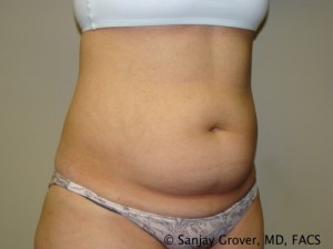 Liposuction Before and After 23 | Sanjay Grover MD FACS