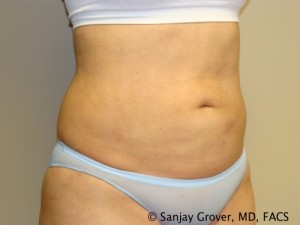 Liposuction Before and After 23 | Sanjay Grover MD FACS