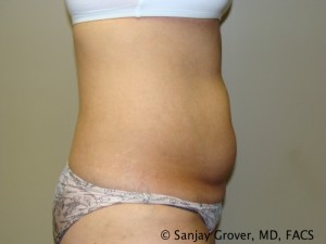 Liposuction Before and After 23 | Sanjay Grover MD FACS