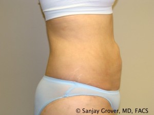 Liposuction Before and After 23 | Grover Aesthetics