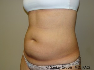 Liposuction Before and After 23 | Grover Aesthetics