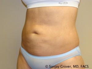 Liposuction Before and After 23 | Grover Aesthetics
