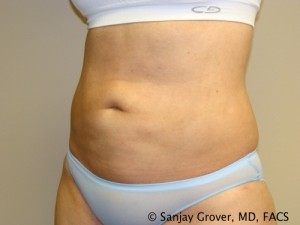 Liposuction Before and After 23 | Sanjay Grover MD FACS