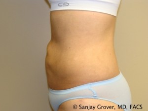 Liposuction Before and After 23 | Sanjay Grover MD FACS