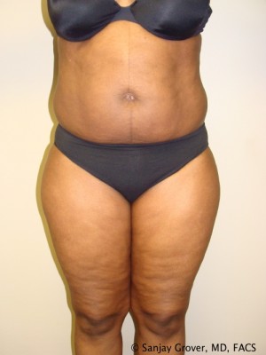 Liposuction Before and After 47 | Sanjay Grover MD FACS