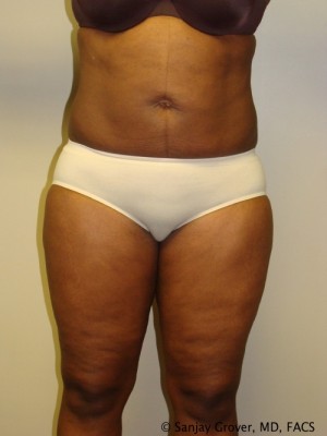 Liposuction Before and After 24 | Sanjay Grover MD FACS