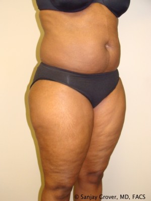 Liposuction Before and After 24 | Grover Aesthetics