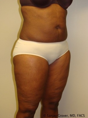 Liposuction Before and After 24 | Sanjay Grover MD FACS