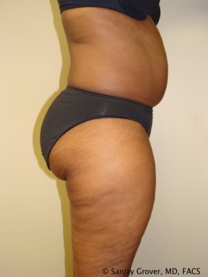 Liposuction Before and After 24 | Grover Aesthetics