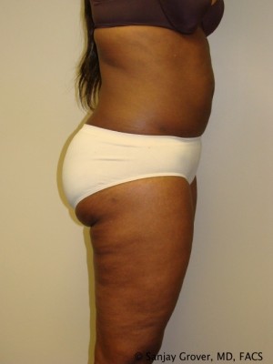 Liposuction Before and After 24 | Grover Aesthetics