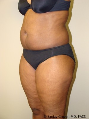 Liposuction Before and After 24 | Grover Aesthetics