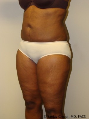 Liposuction Before and After 24 | Grover Aesthetics
