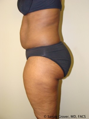 Liposuction Before and After 24 | Grover Aesthetics