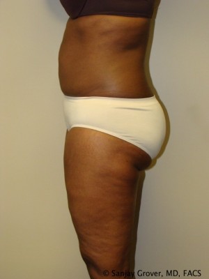 Liposuction Before and After 24 | Sanjay Grover MD FACS