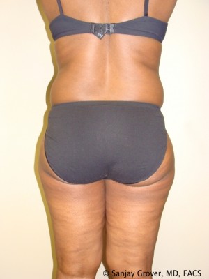 Liposuction Before and After 24 | Grover Aesthetics